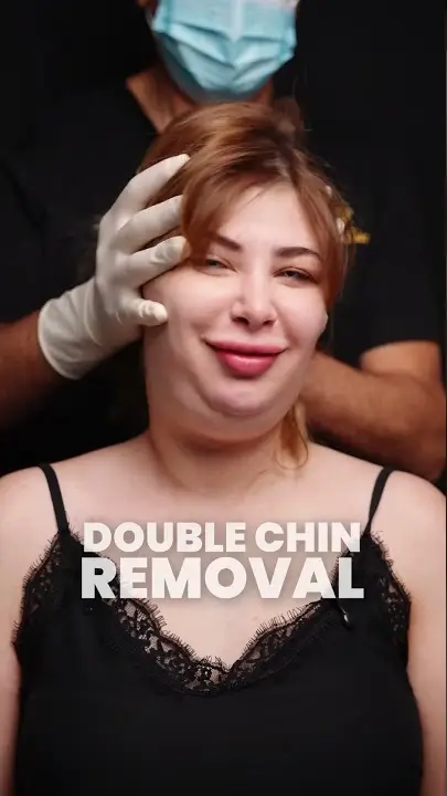 Dr. Nader — Double Chin