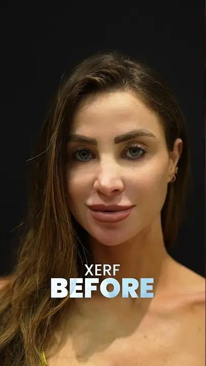 XERF — Before / After